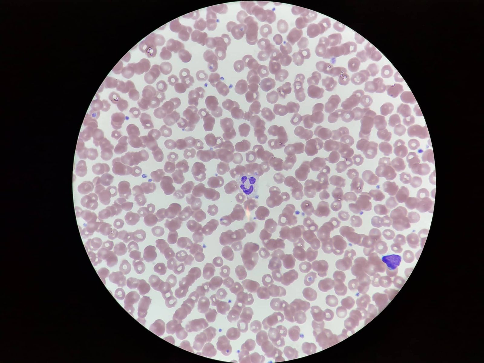 A microscope view of a stained blood smear with red blood cells surrounding one purple multilobed neutrophil at center